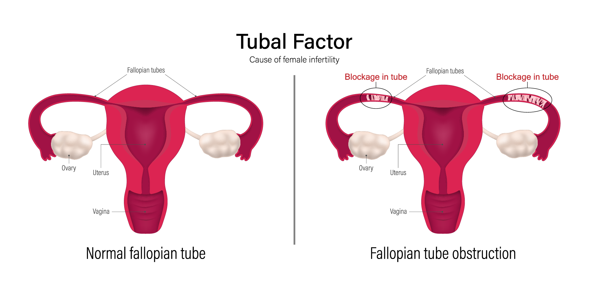 Infertility_Disease Background 3