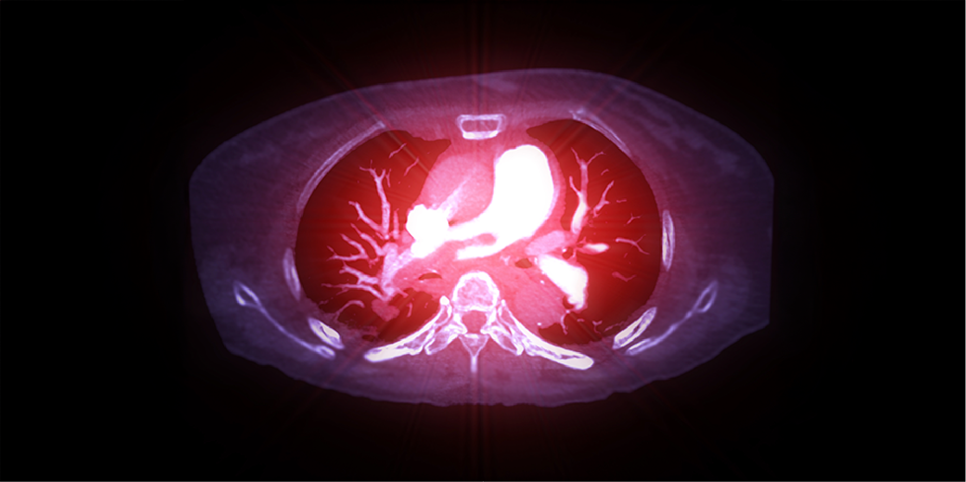 Pulmonary Thromboembolism_Diagnostics 2