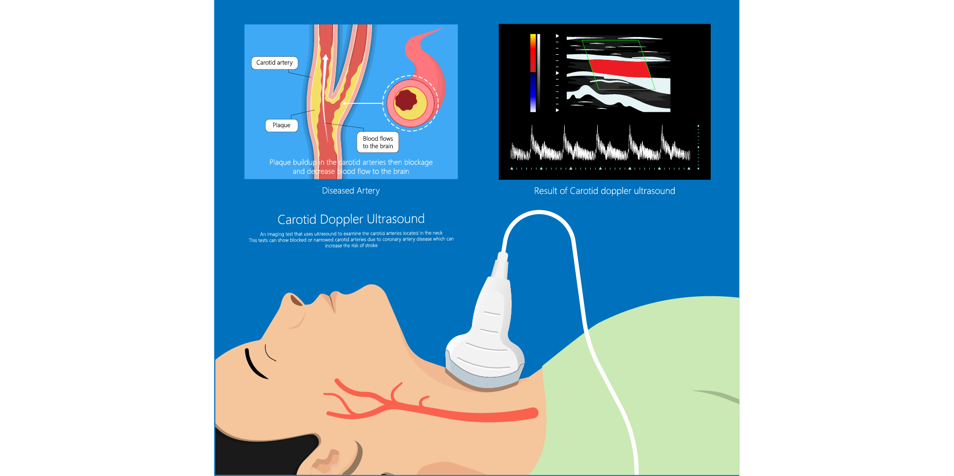 Ischemic Stroke_Diagnotics 3