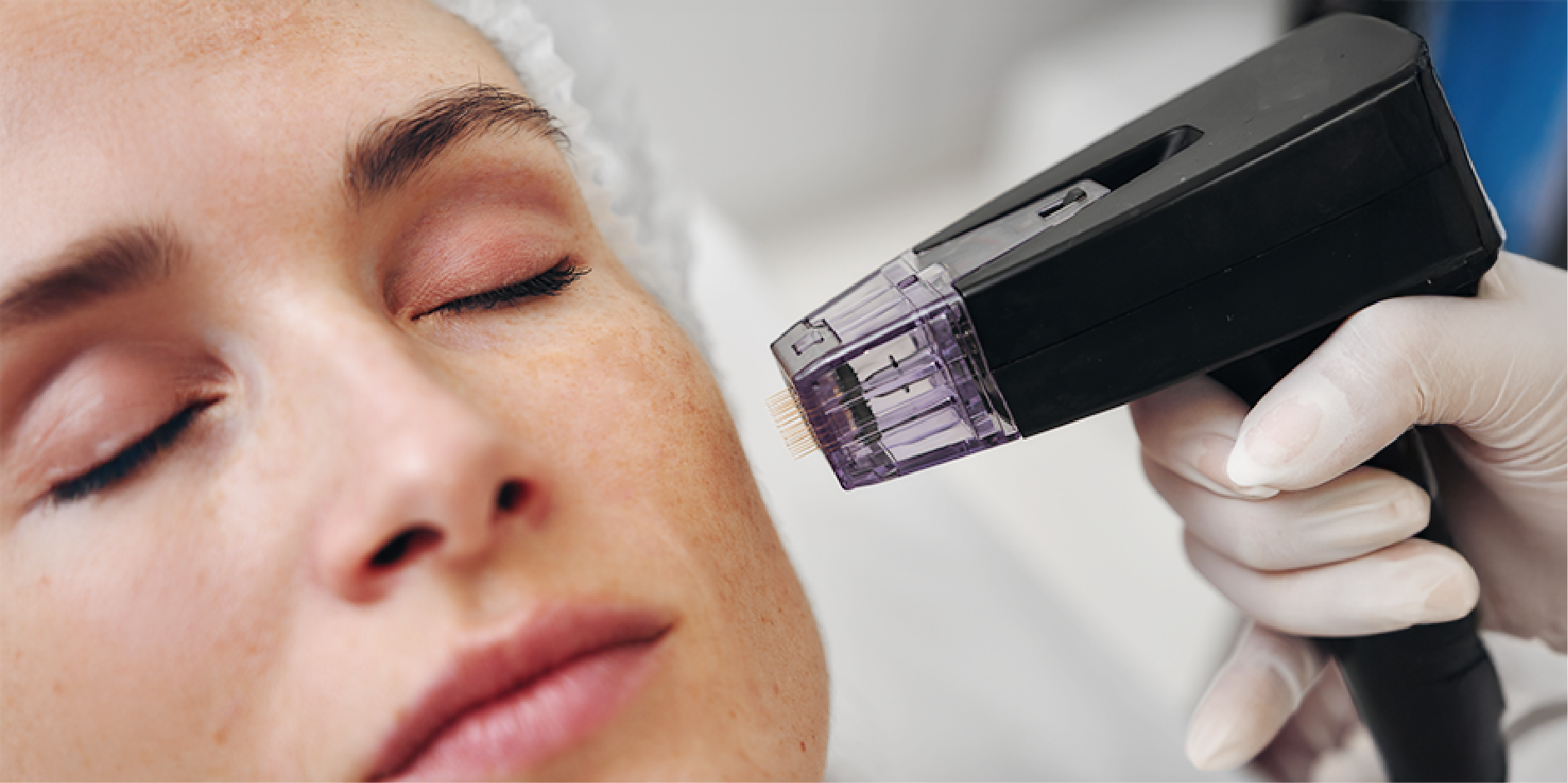 Melasma_Management 8