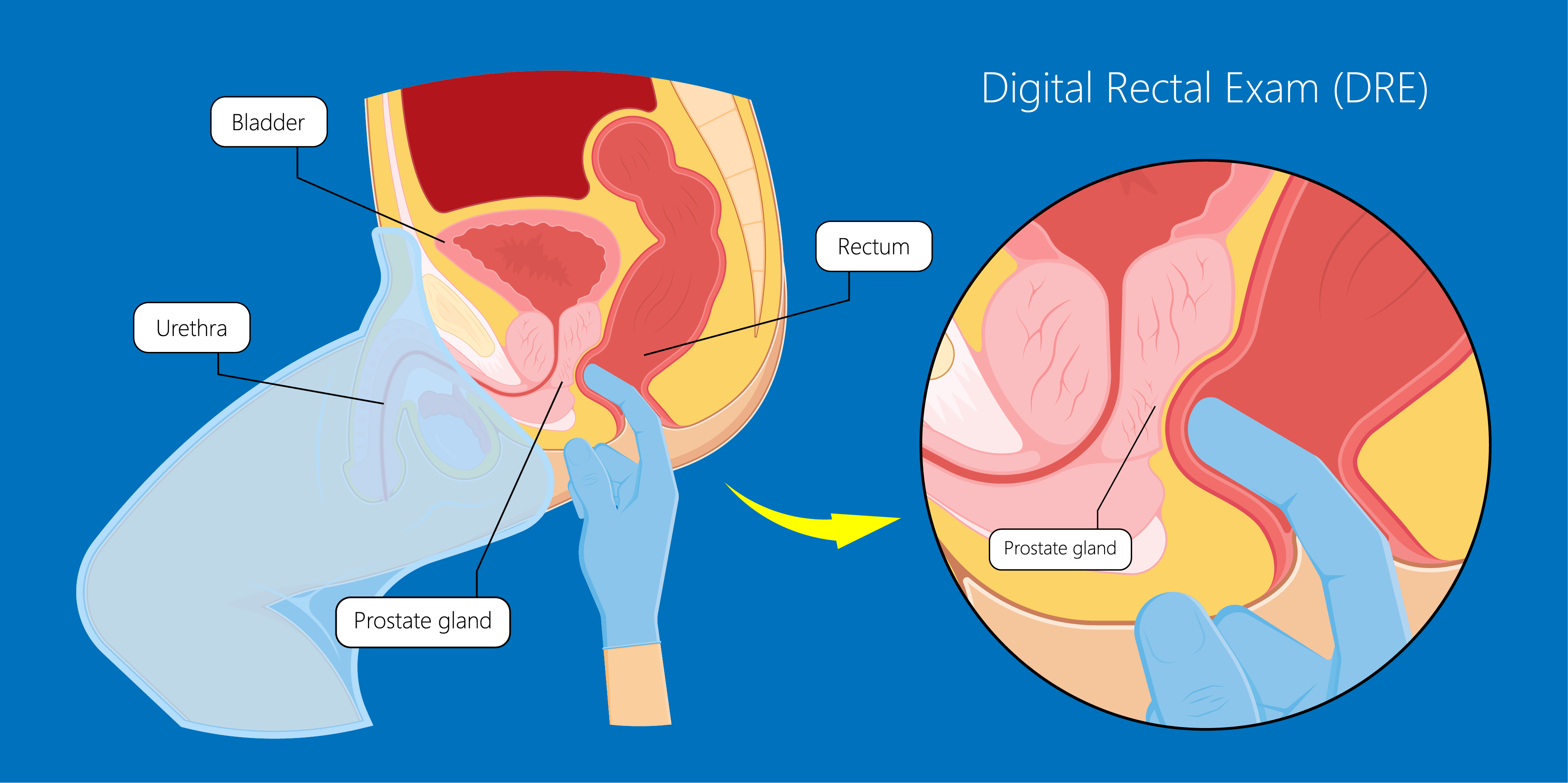 Prostate Cancer_Initial Assesment 1