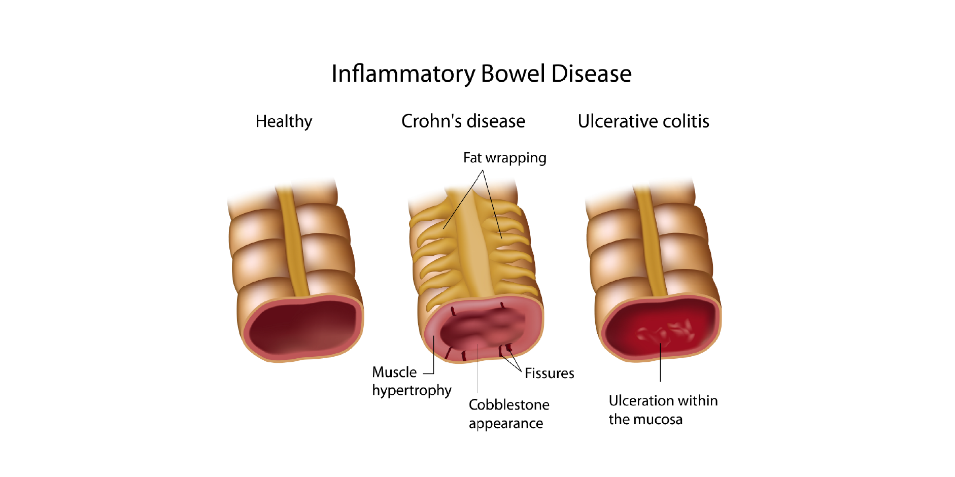 Inflammatory Bowel Disease_Diagnotics 3