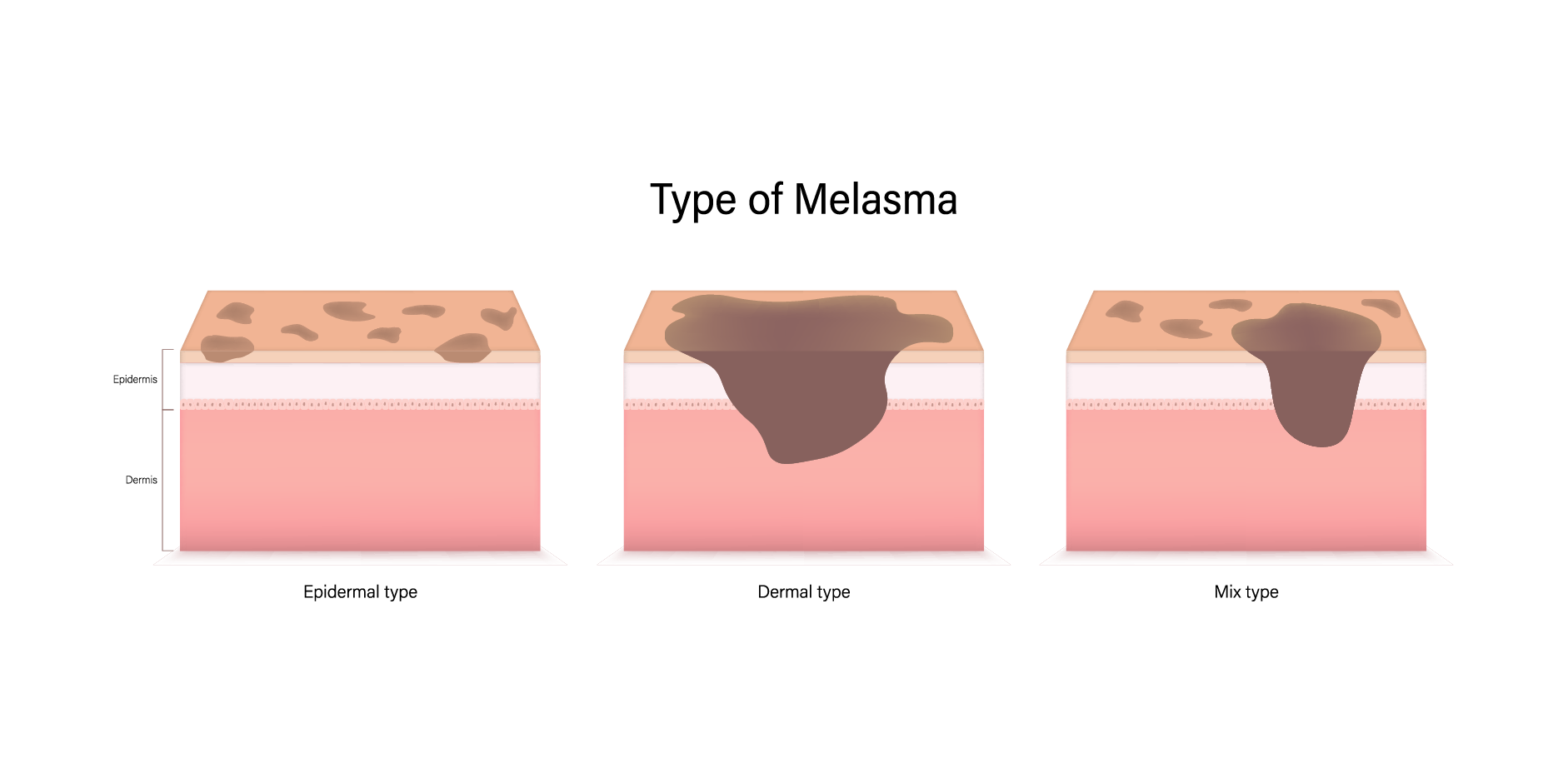 Melasma_Disease Background
