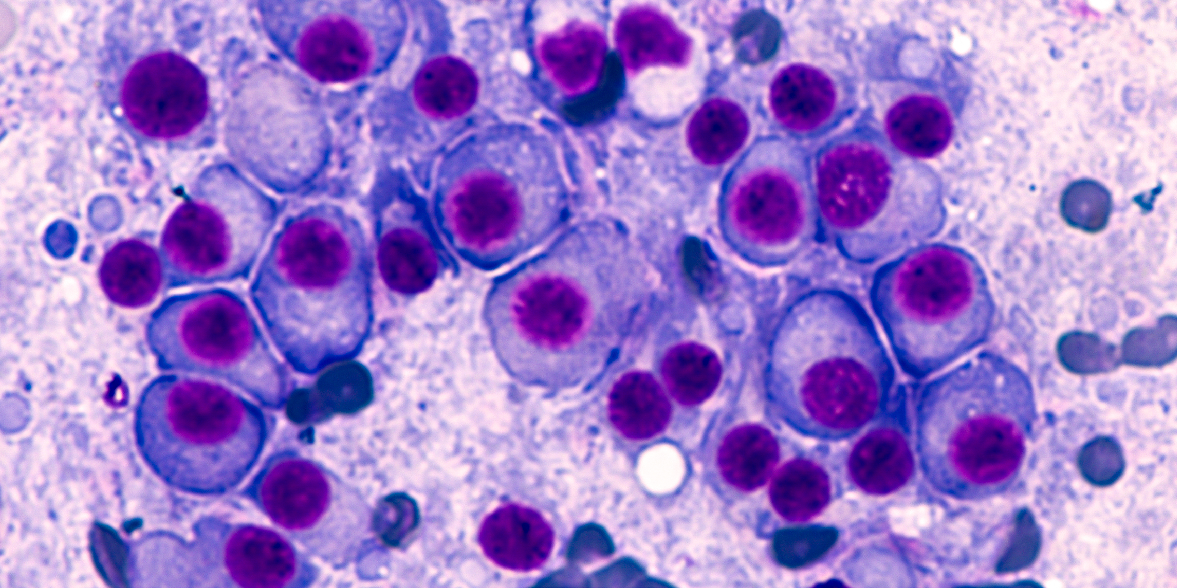 Multiple Myeloma_Disease Summary