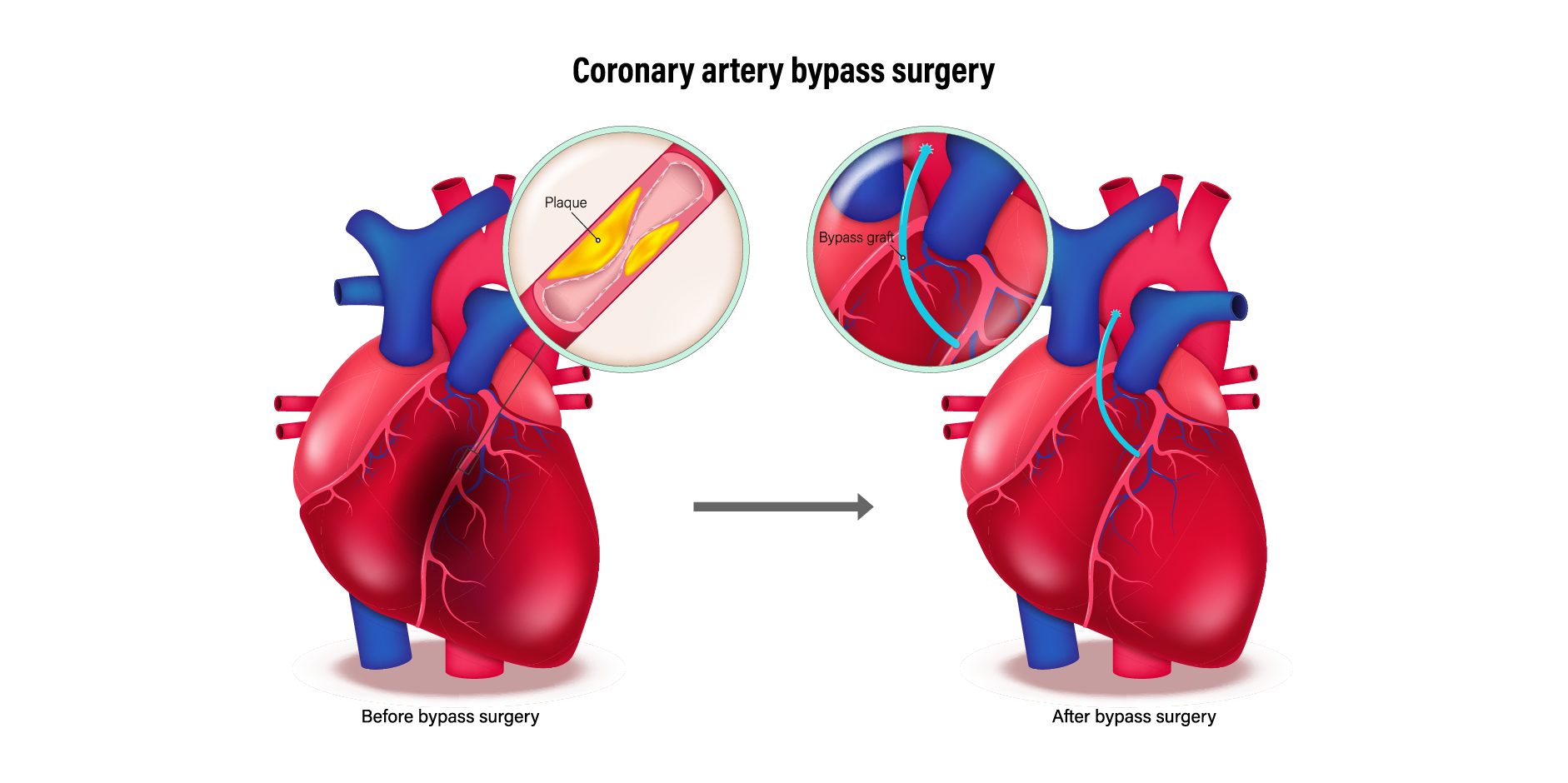 Chronic Coronary Syndromes_Management 13