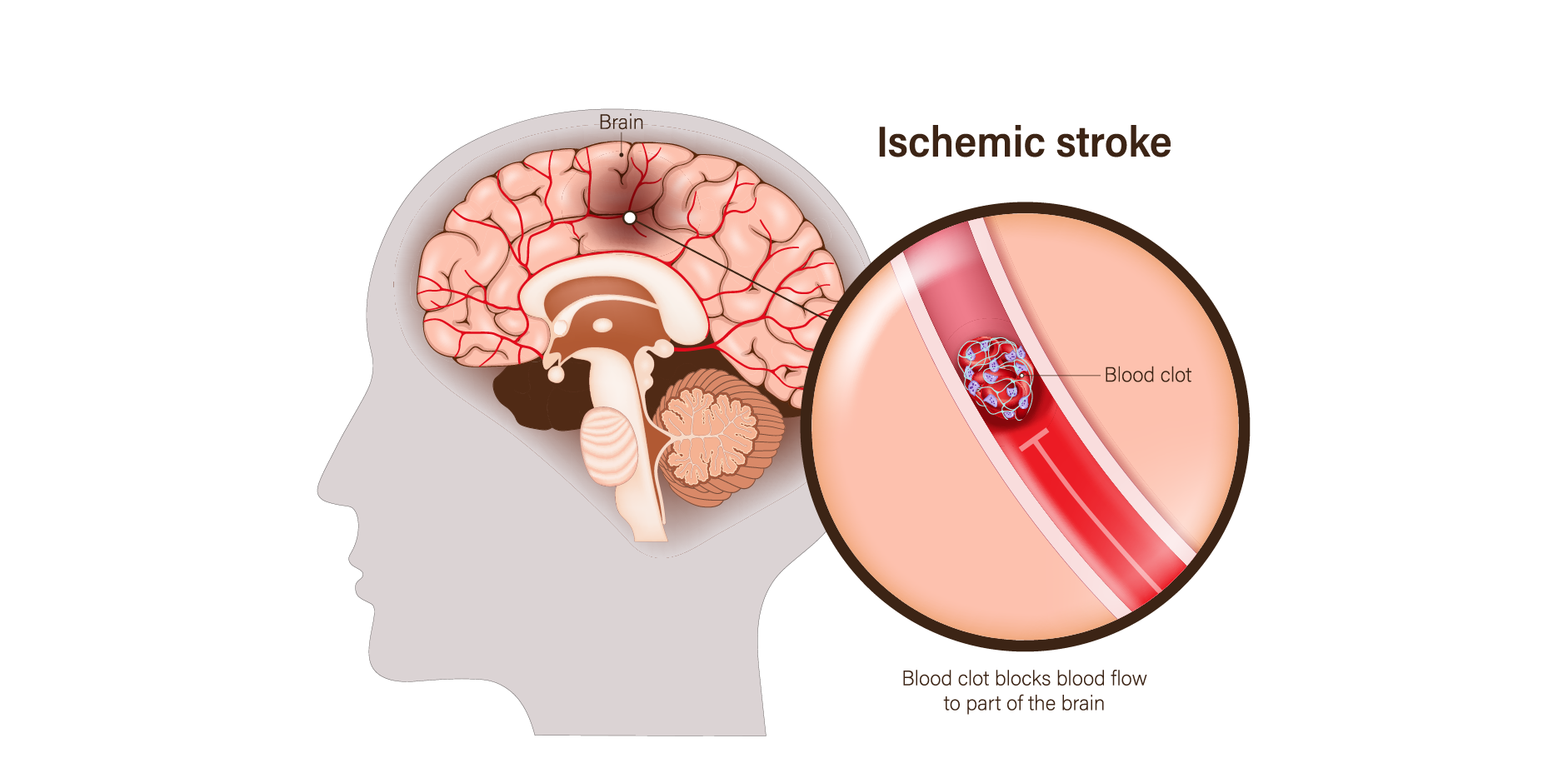 Ischemic Stroke_Disease Background