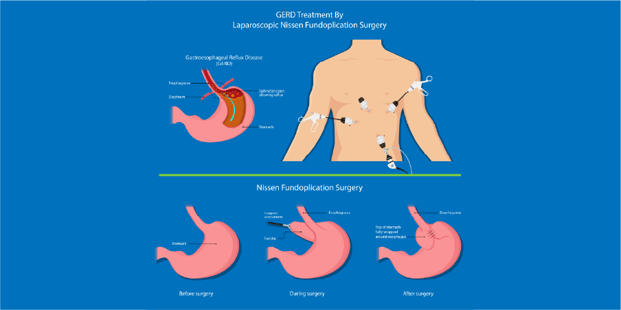 Gastroesophageal Reflux Disease_Management 6