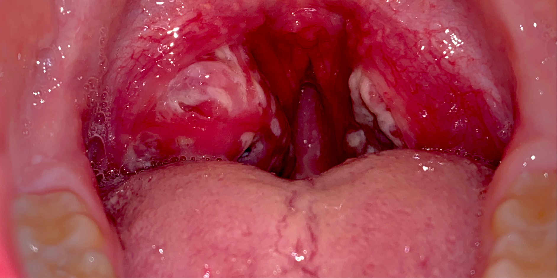 Tonsillopharyngitis - Acute_Initial Assesment