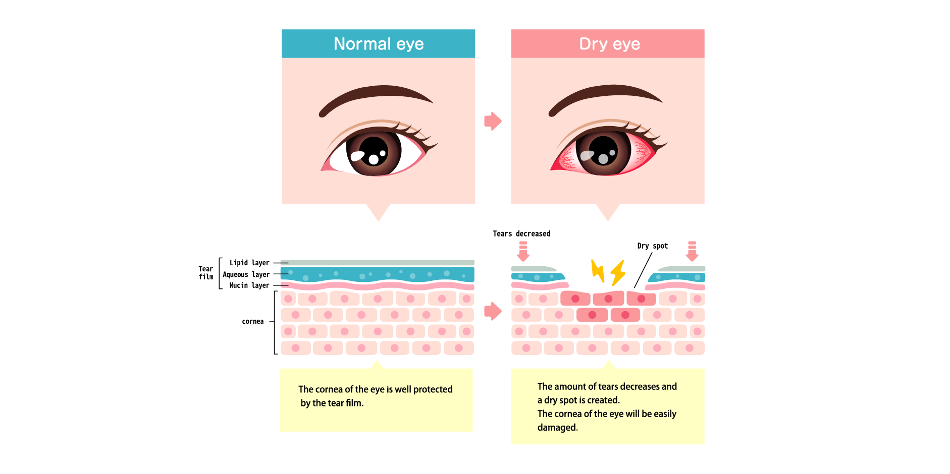 Dry Eye Syndrome : Disease Background | MIMS Malaysia