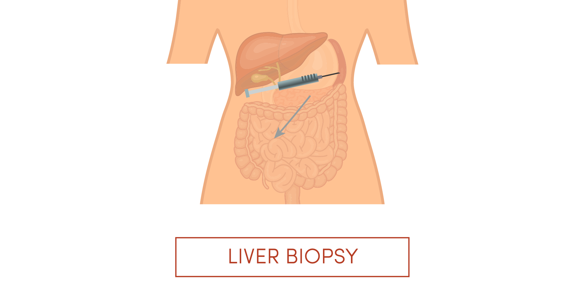 Hepatocellular Carcinoma Diagnostics Mims Thailand