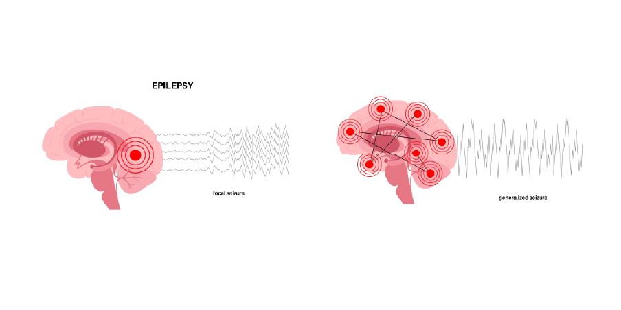 Epilepsy_Initial Assesment 2