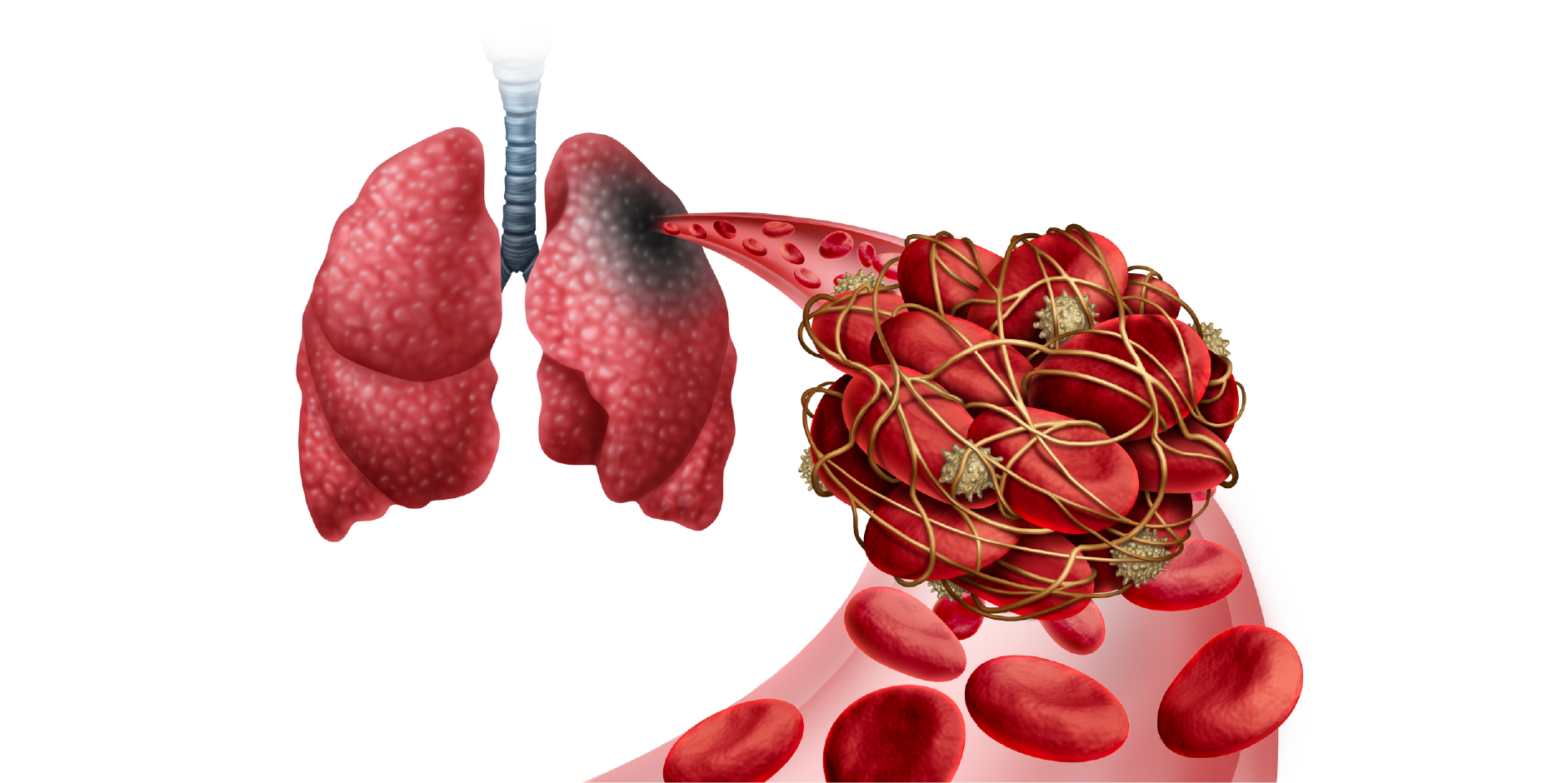 Pulmonary Thromboembolism_Disease Summary