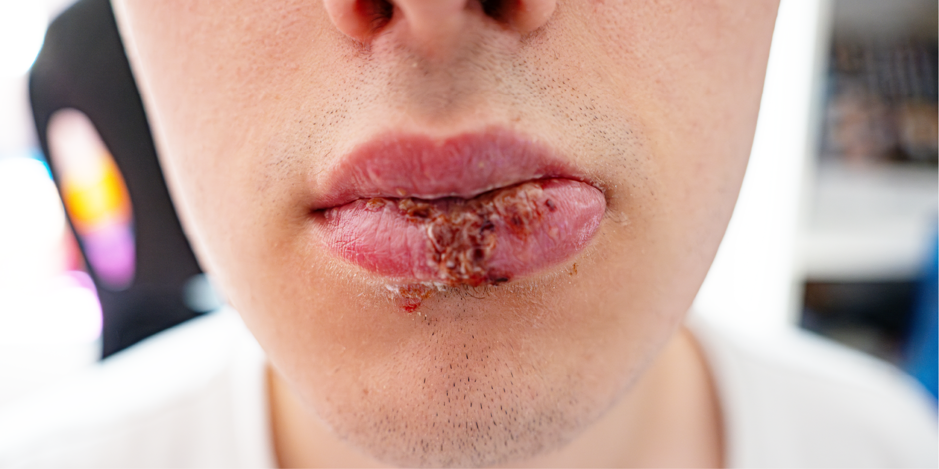 Herpes Simplex Virus Infection_Initial Assesment 1