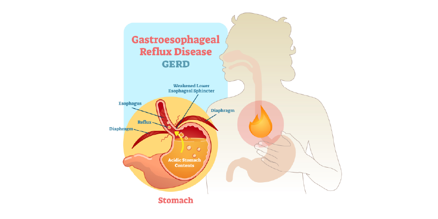 Gastroesophageal Reflux Disease_Disease Background 2