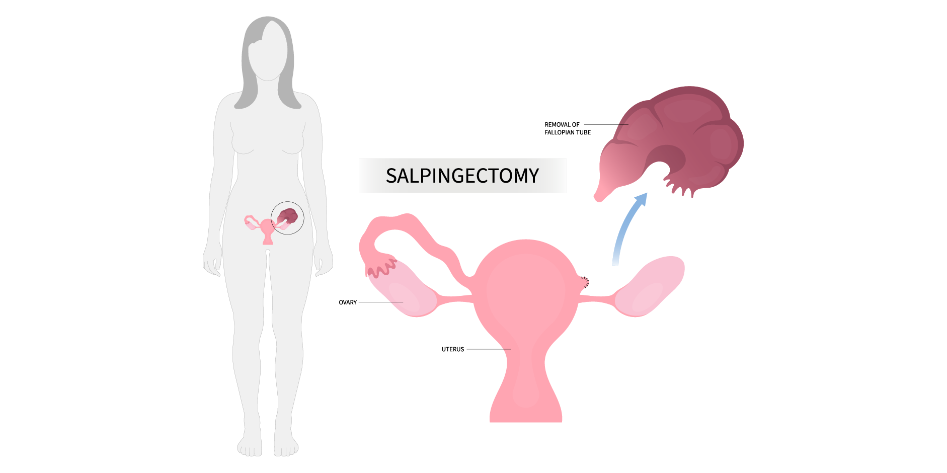 Endometrial Cancer_Management 2