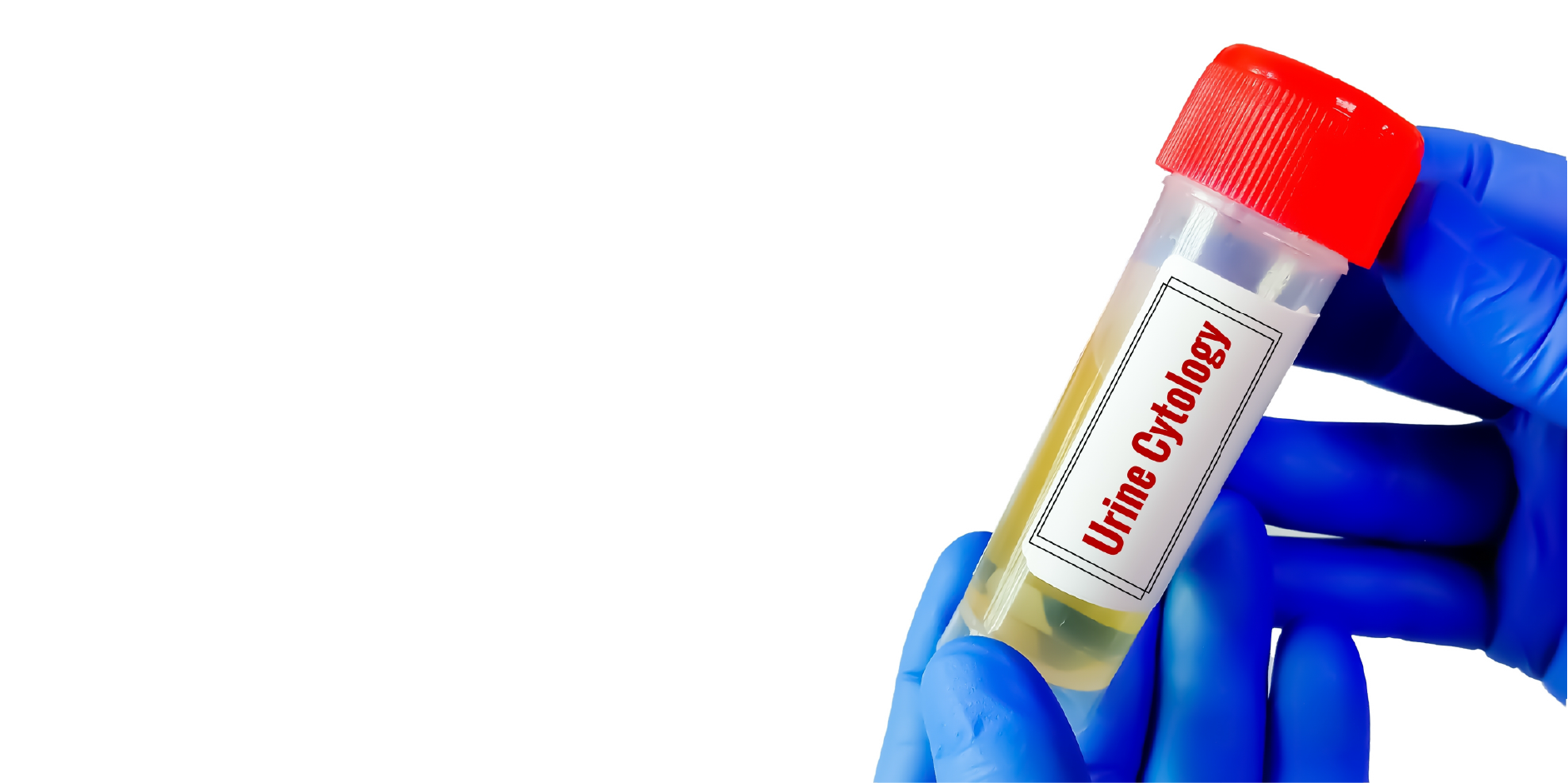 Bladder Cancer_Diagnostics 1