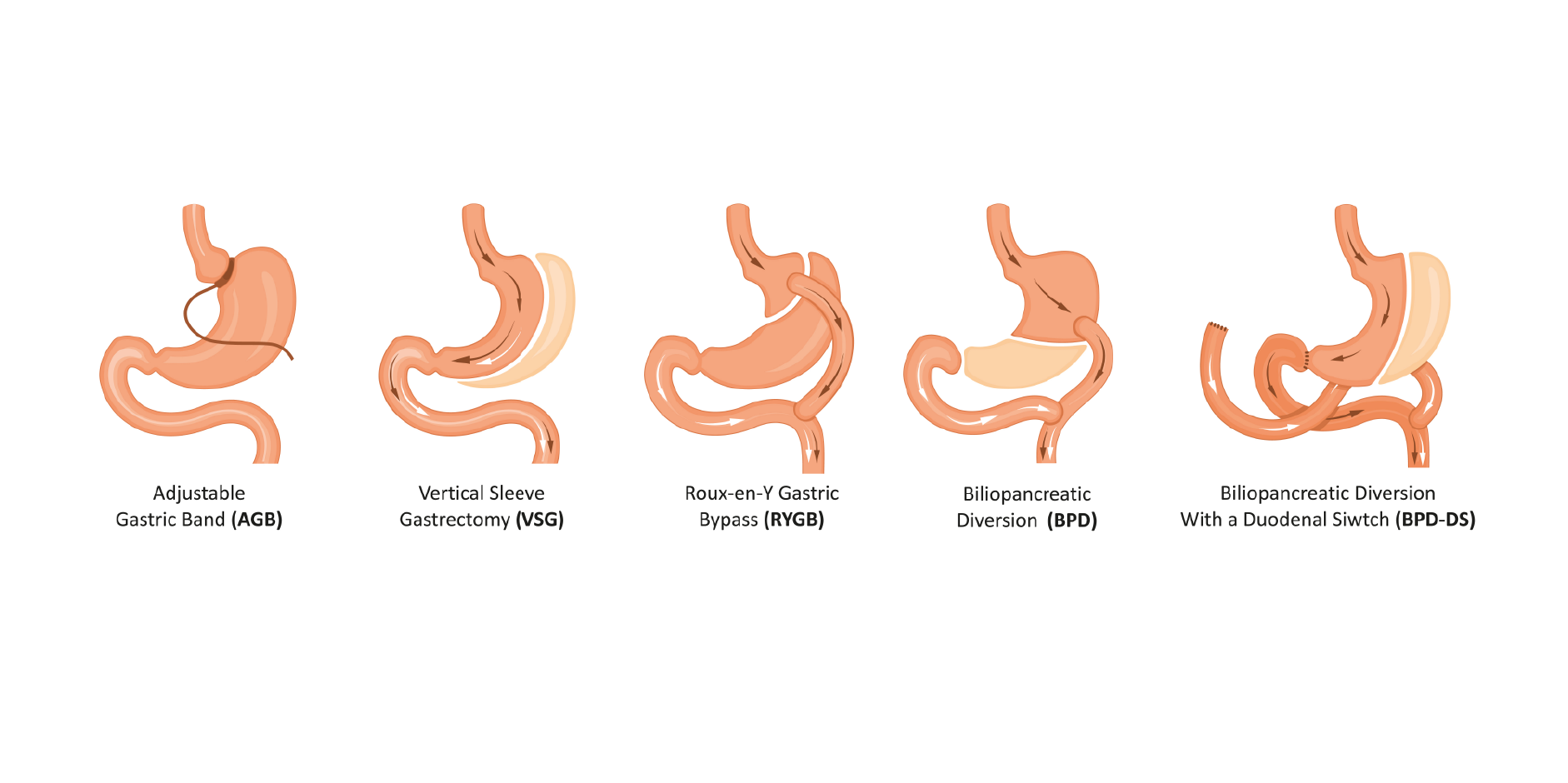 Obesity_Surgery