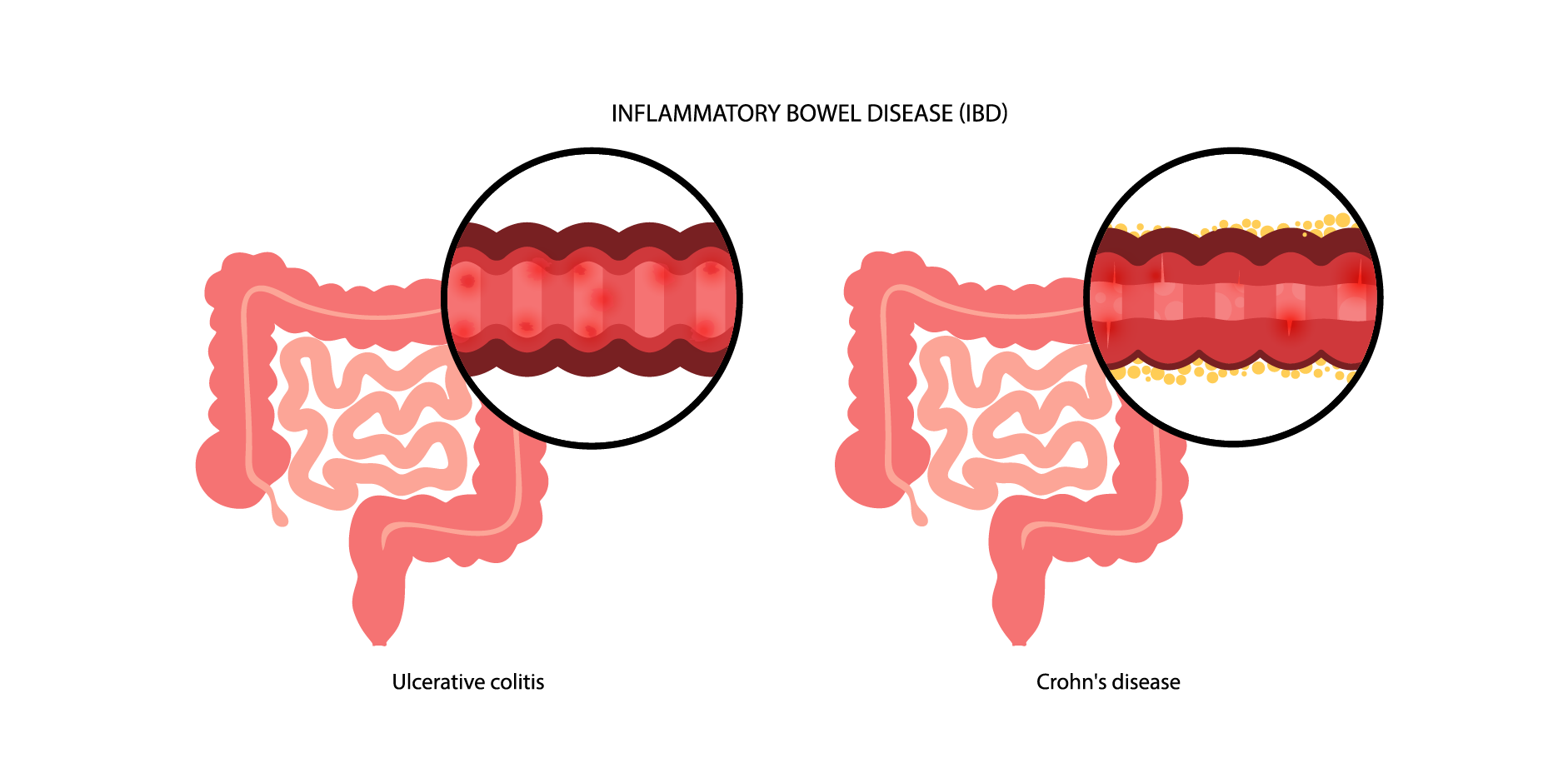 Inflammatory Bowel Disease_Disease Background