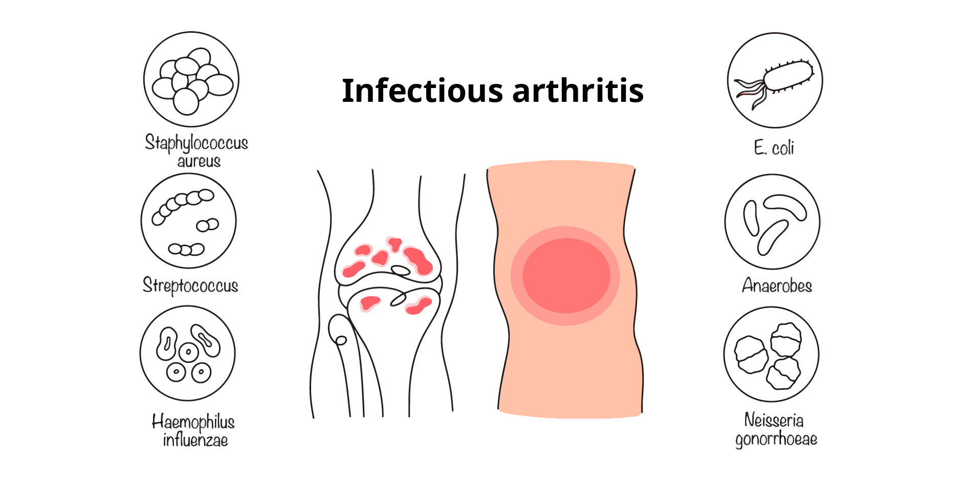 Infectious Arthritis_Disease Background
