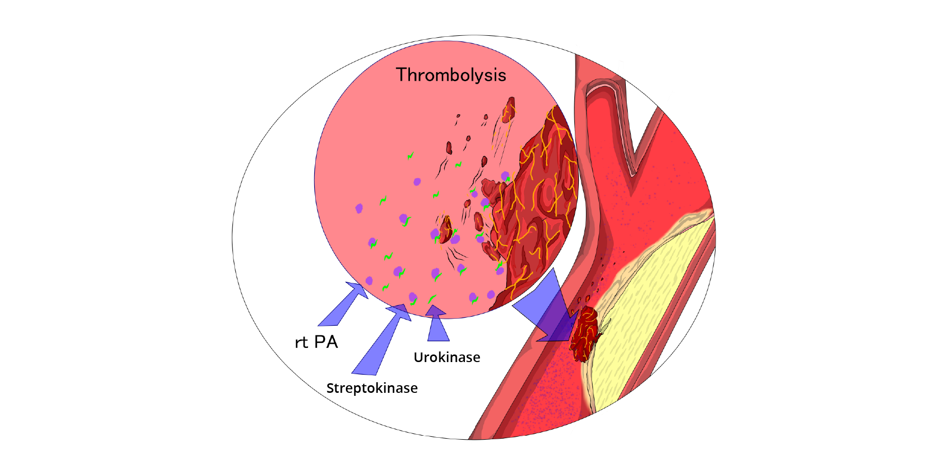Pulmonary Thromboembolism_Management 1