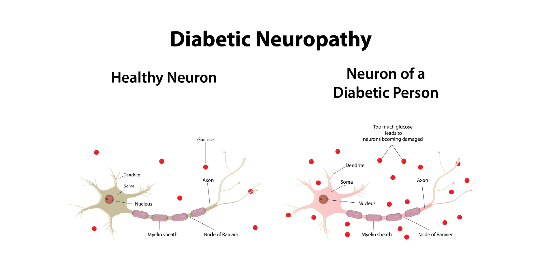 Diabetic Neuropathy_Disease Background