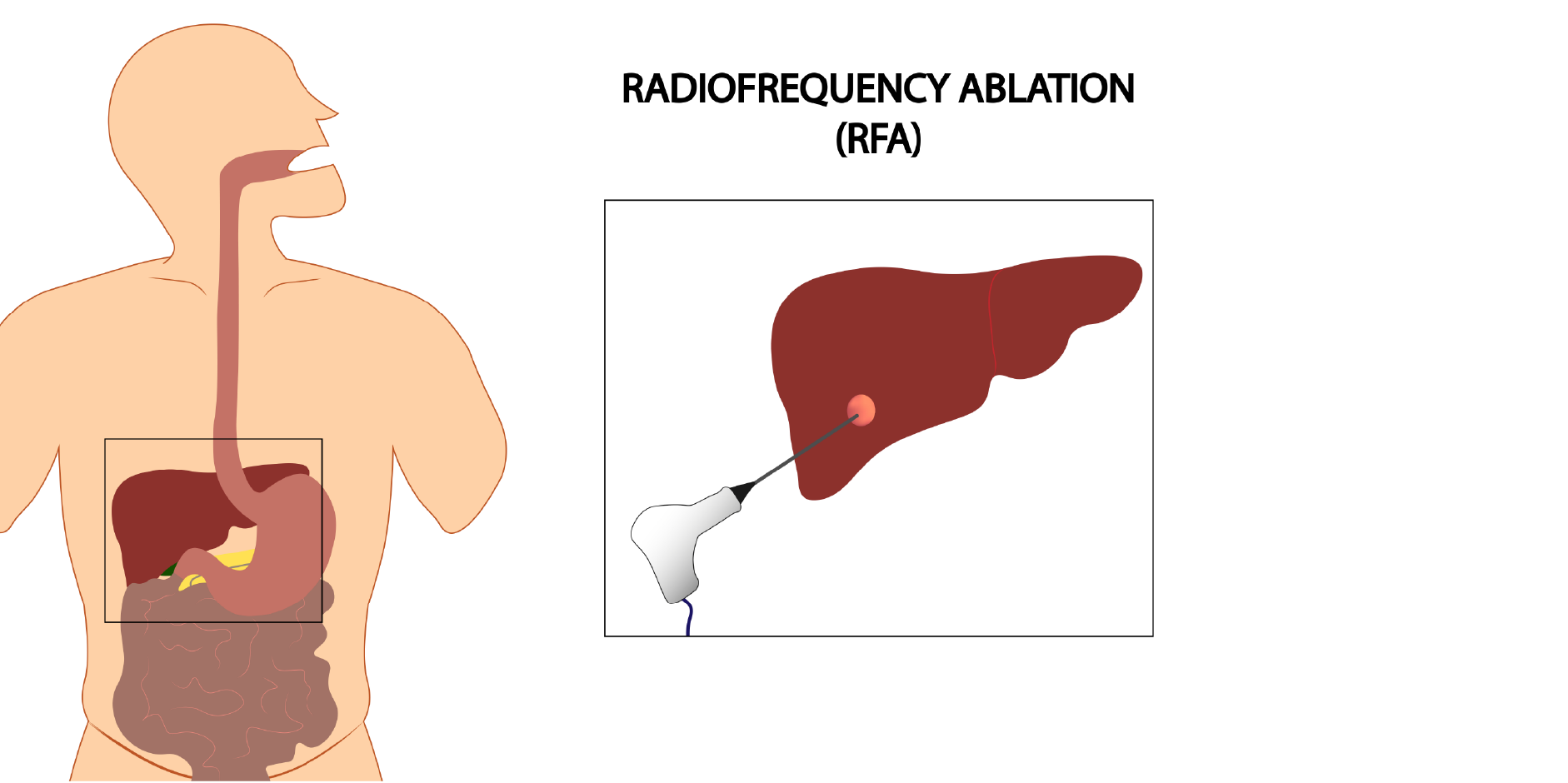 Hepatocellular Carcinoma Management Mims Indonesia
