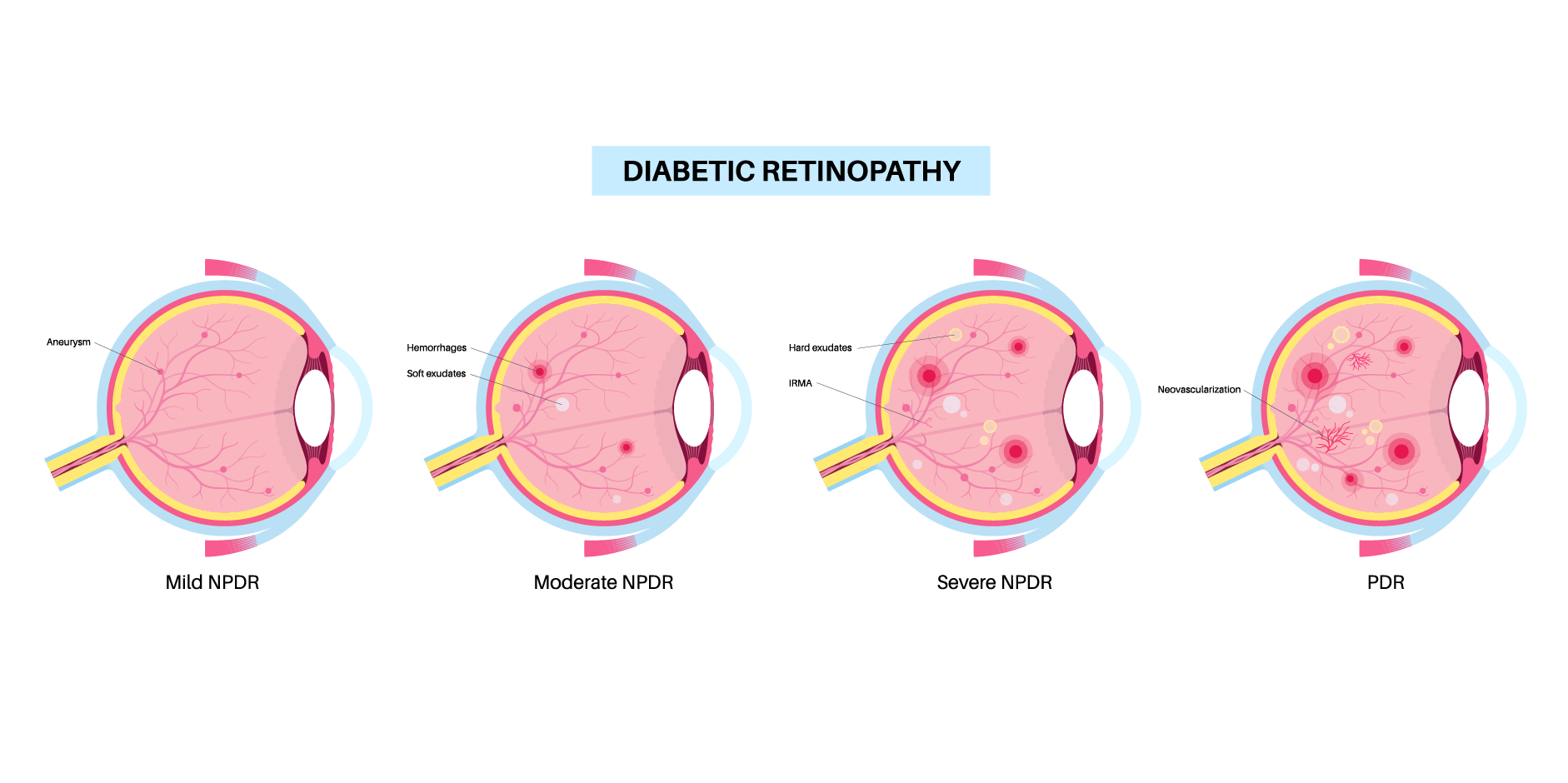 Diabetic Retinopathy_Disease Background 2