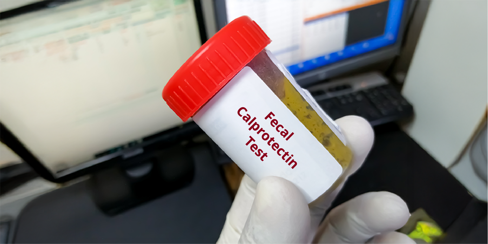 Inflammatory Bowel Disease_Diagnotics 1