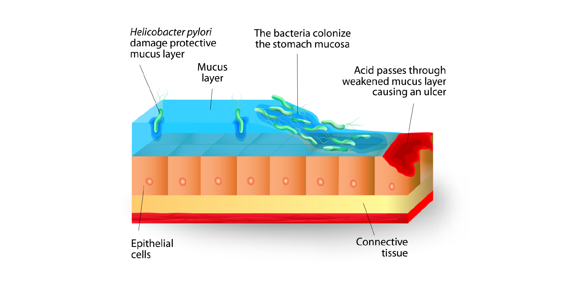 Peptic Ulcer Disease_Disease Background