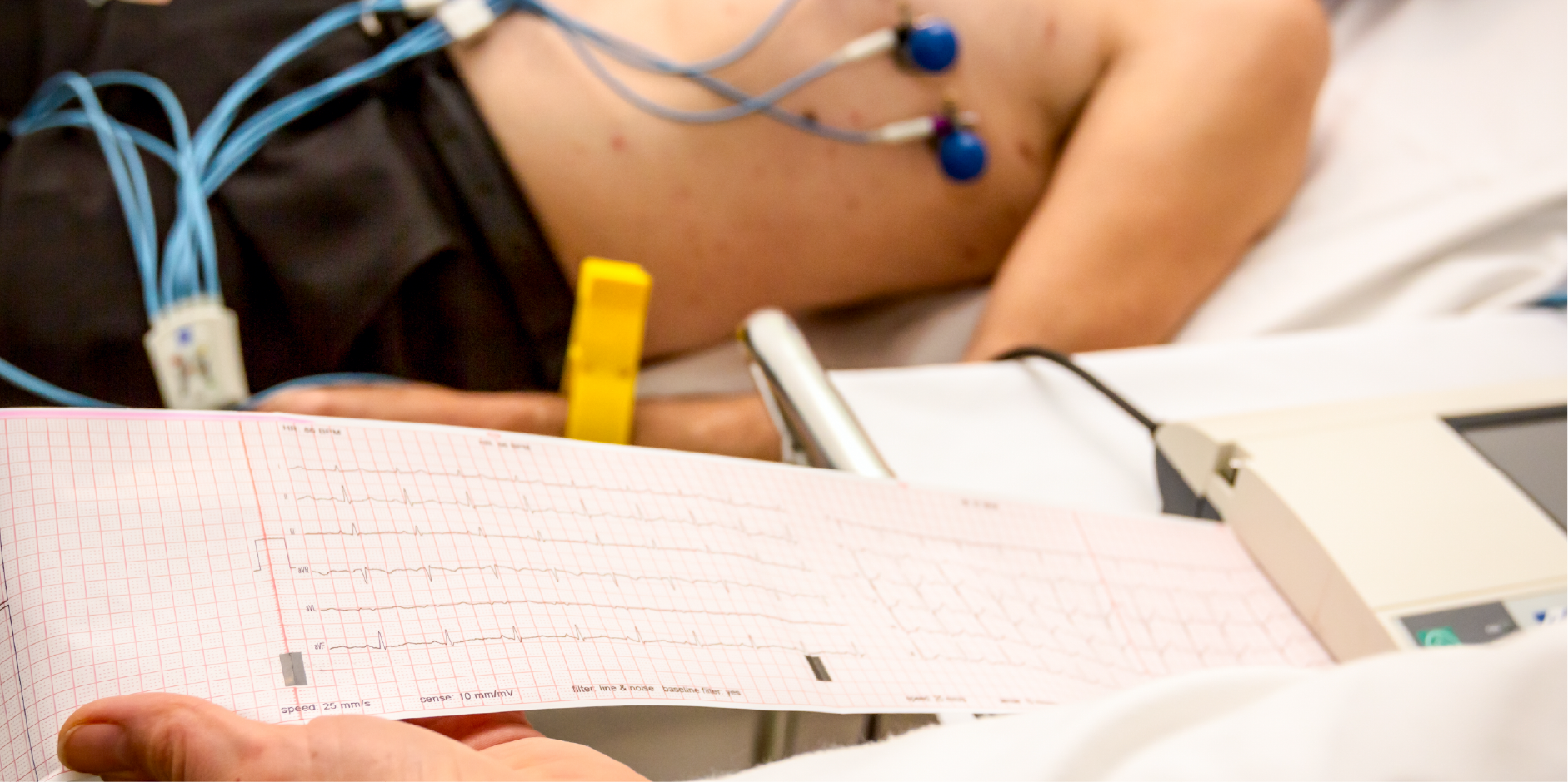 Myocardial Infarction w ST-Segment Elevation_Diagnostics 1