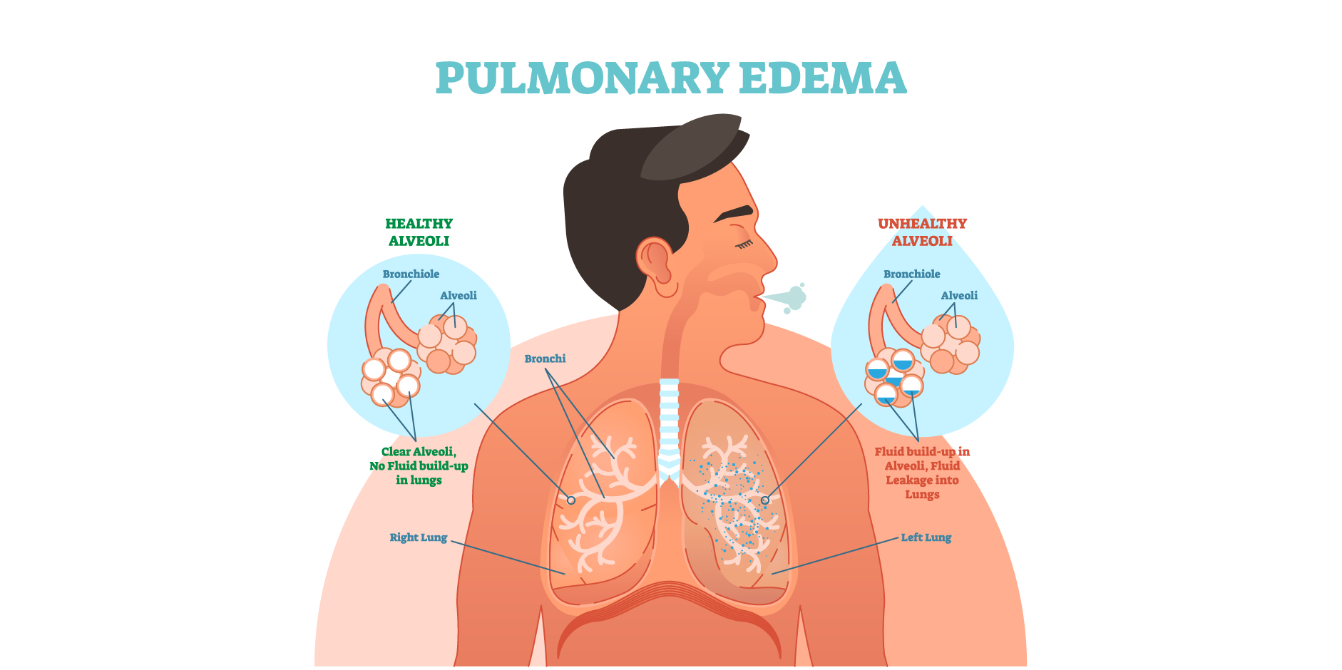 Heart Failure - Acute_Disease Background