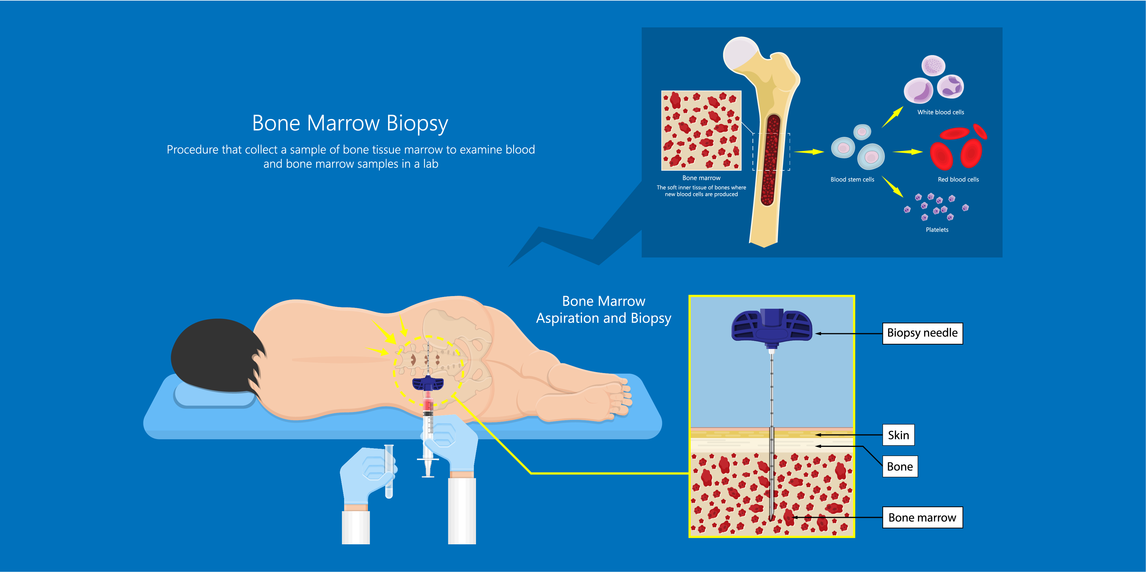 Multiple Myeloma_Diagnostics