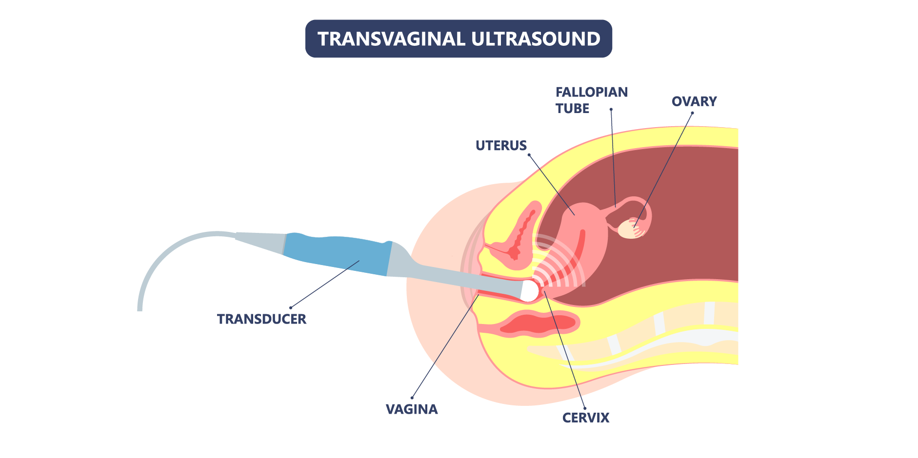 Endometriosis_Diagnostics