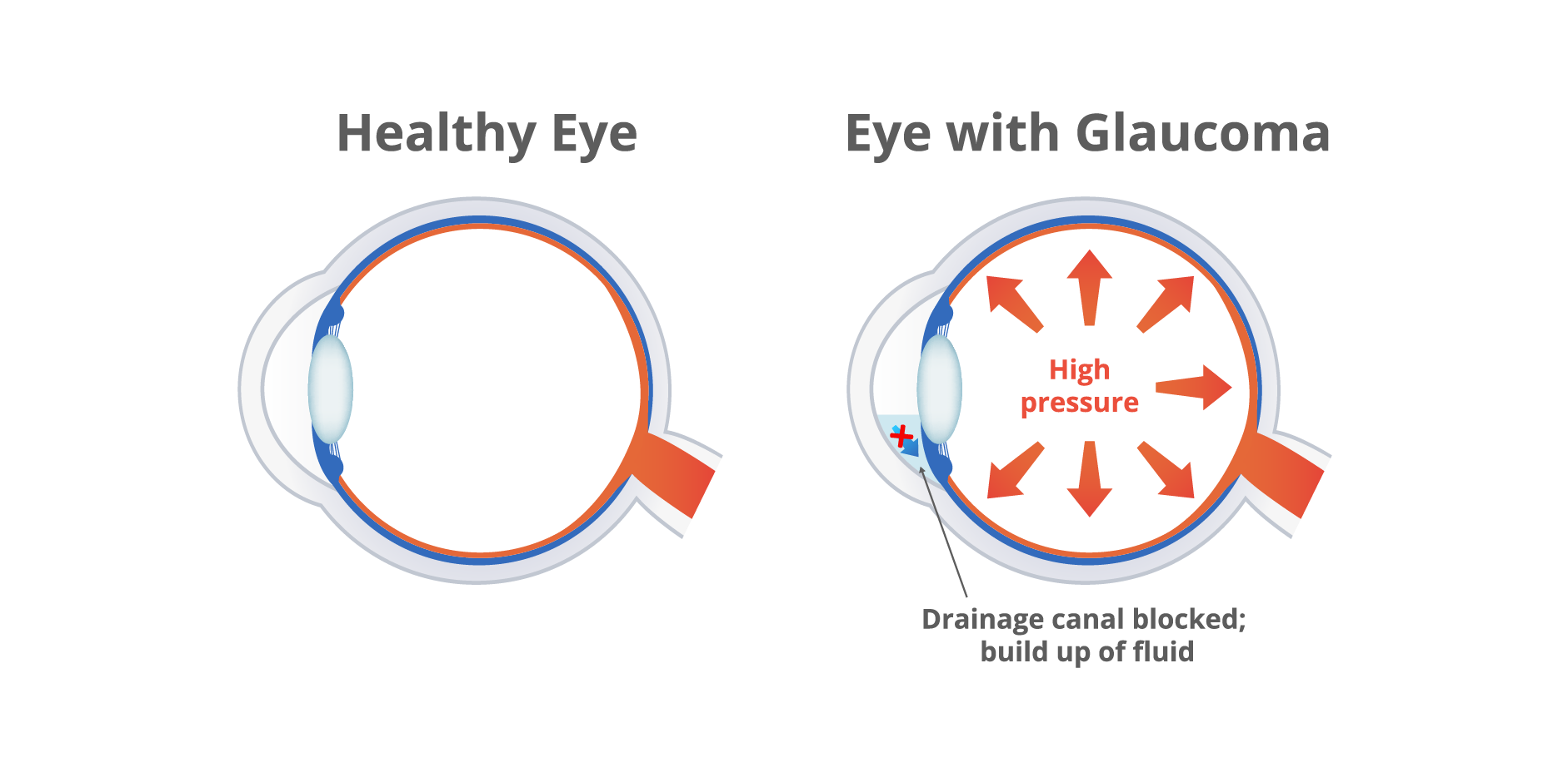 Primary Angle-Closure Glaucoma_Disease Background