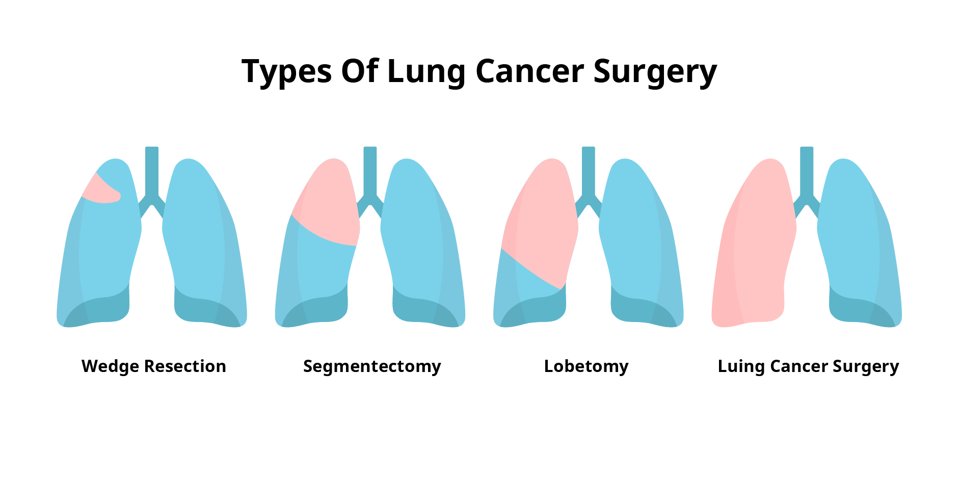 Lung Cancer_Management1