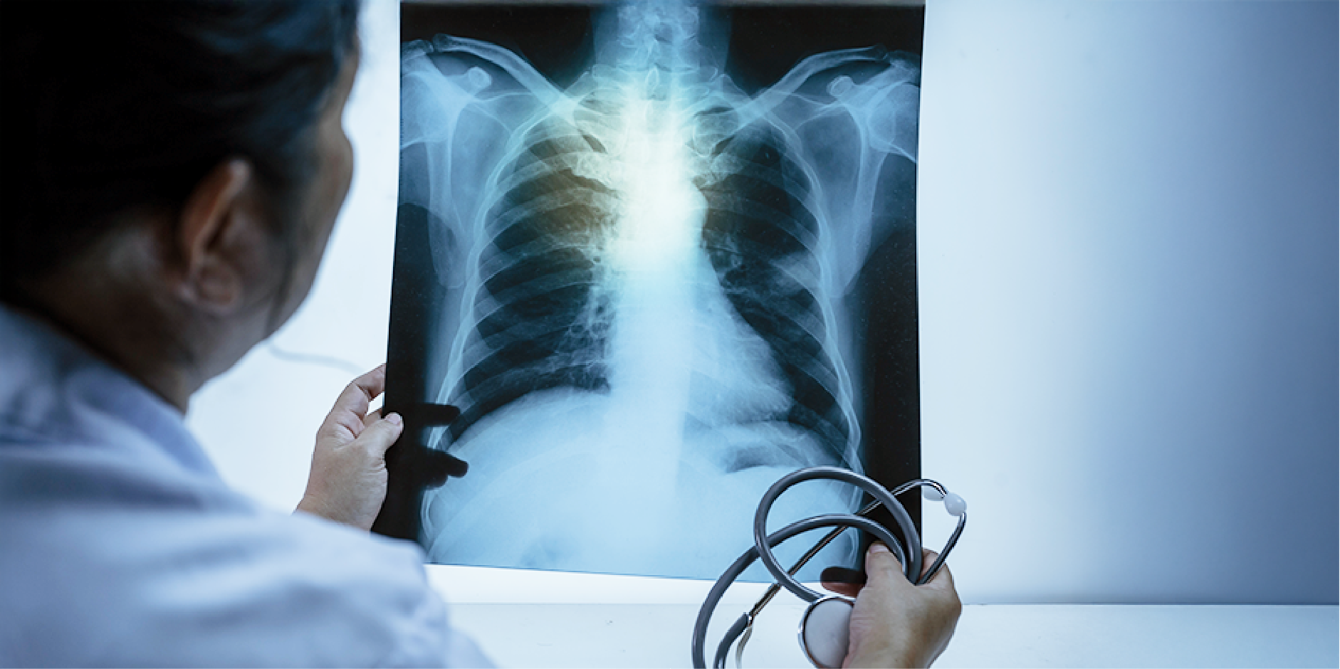 Pneumonia - Hospital-Acquired_Diagnostics