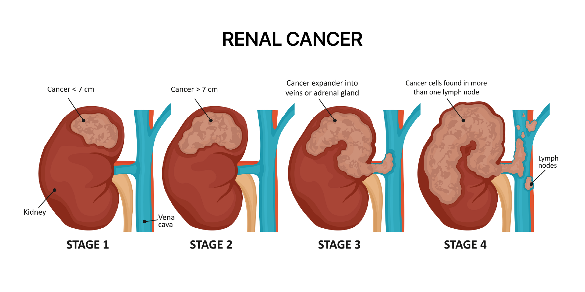 Renal Cancer_Management