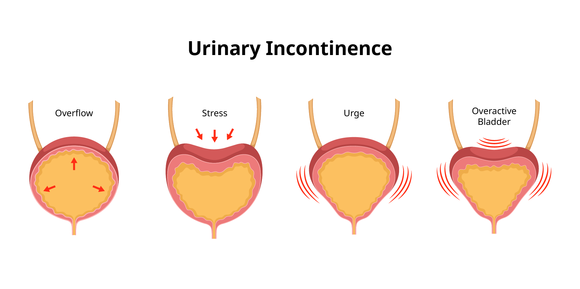 Urinary Incontinence_Disease Background