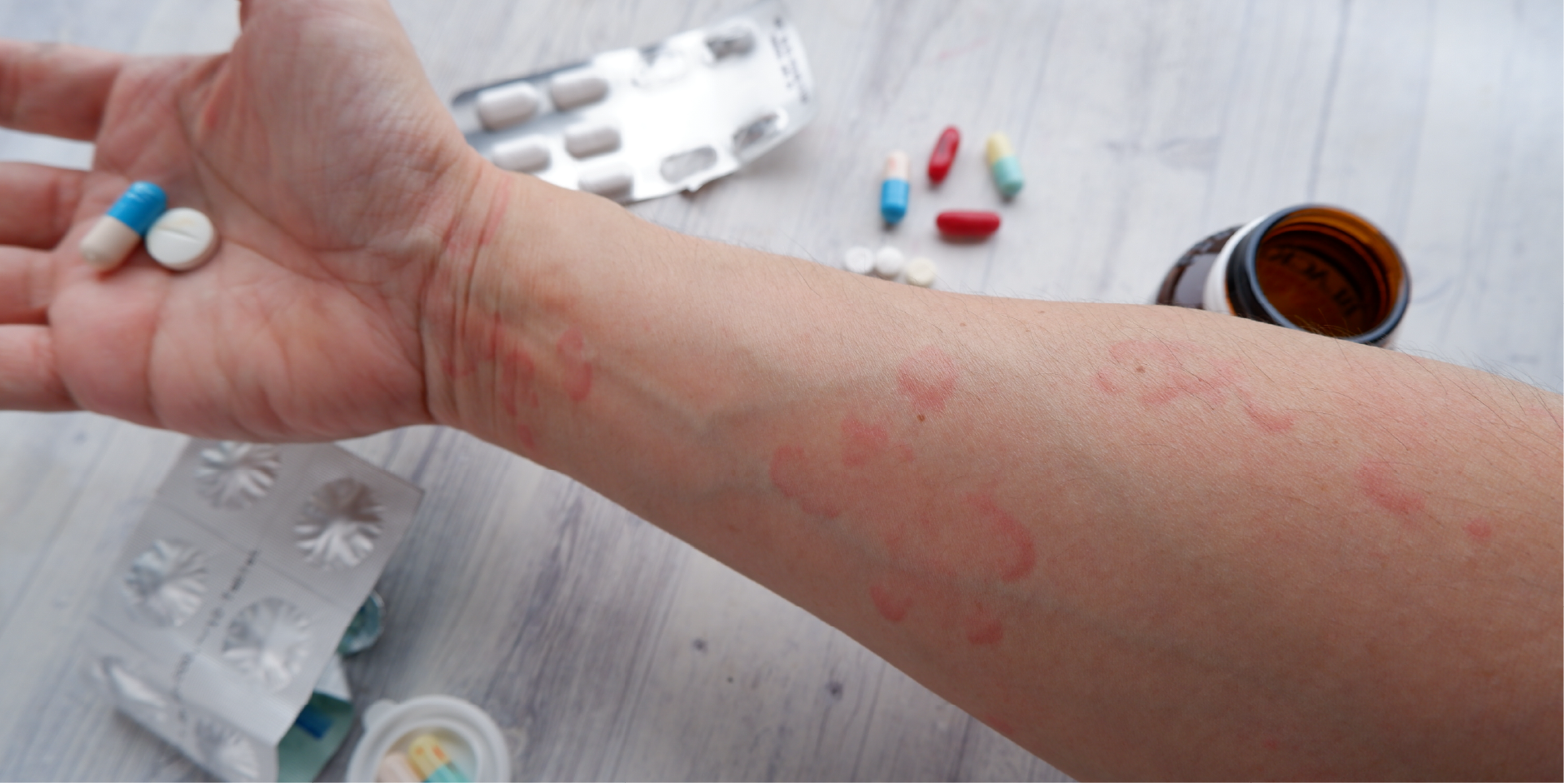 Urticaria_Management
