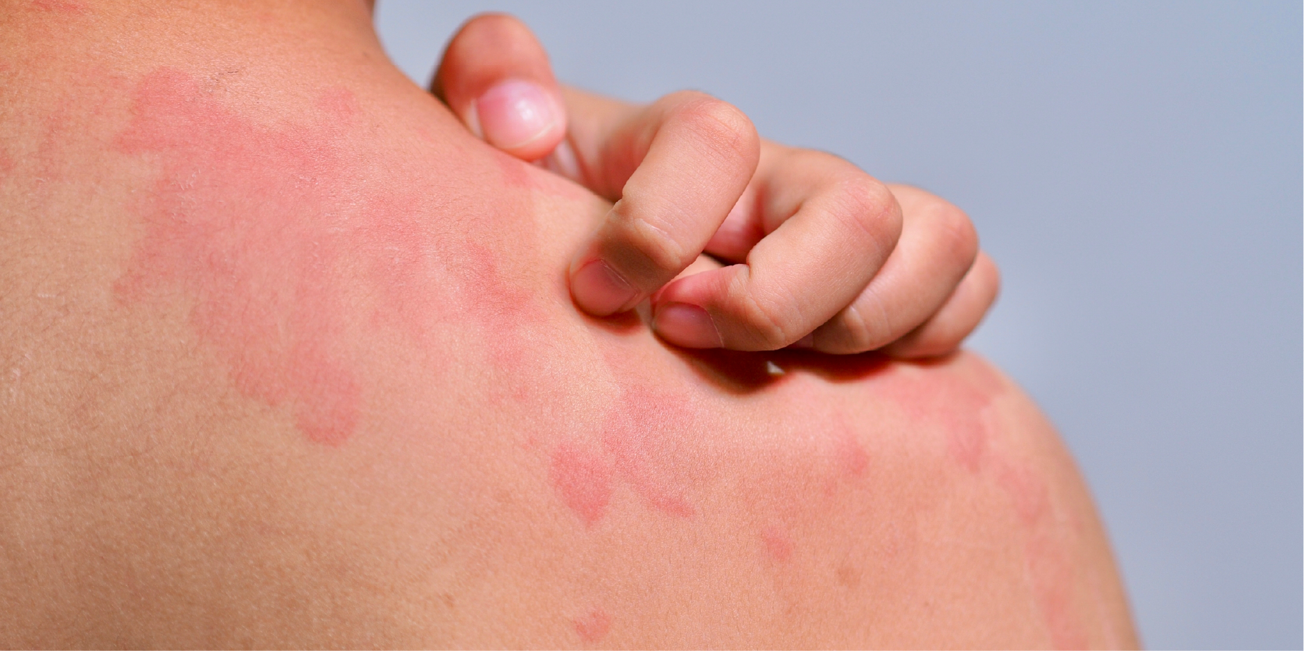 Urticaria_Disease Summary