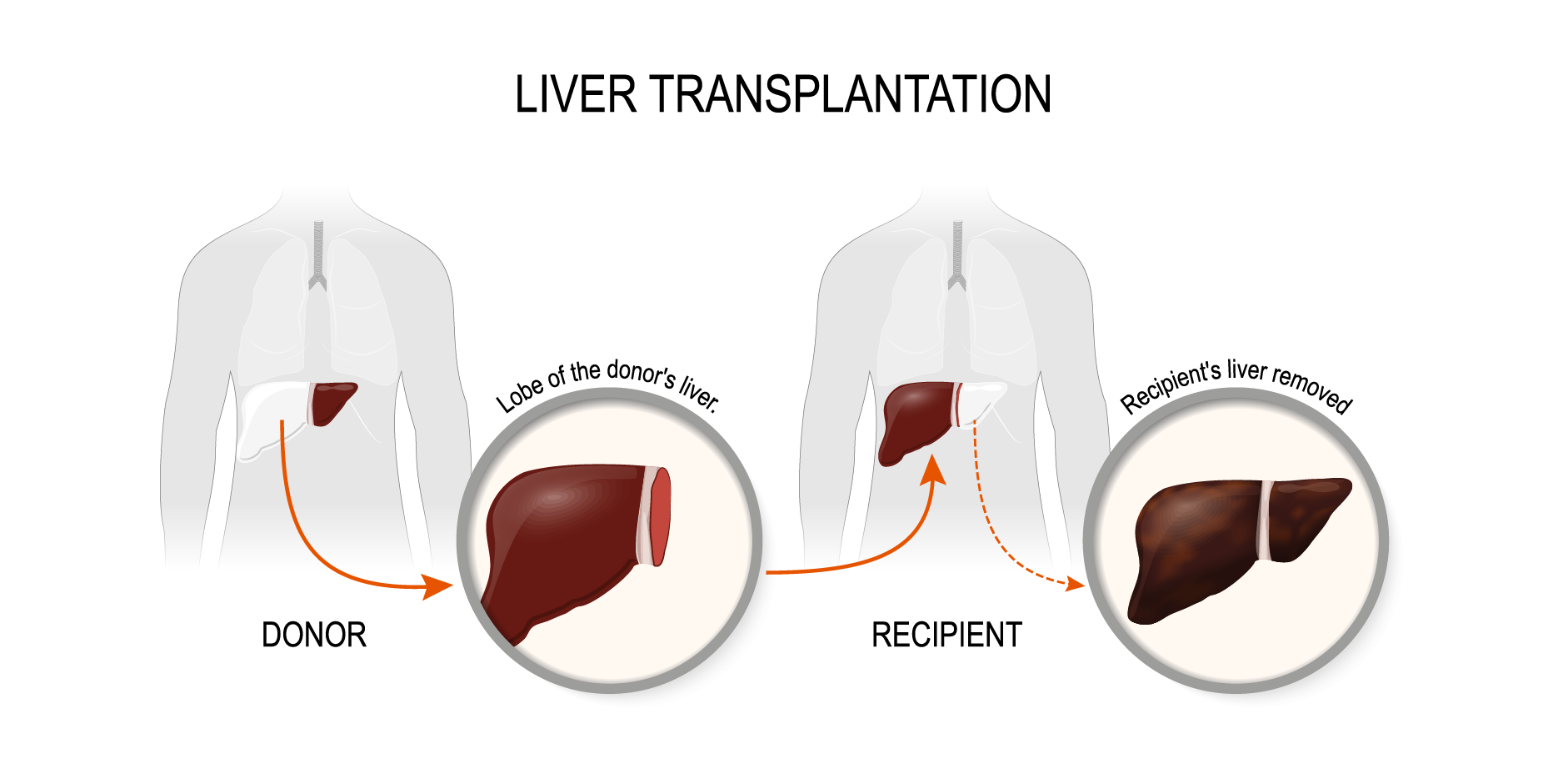Hepatocellular Carcinoma Management Mims Indonesia