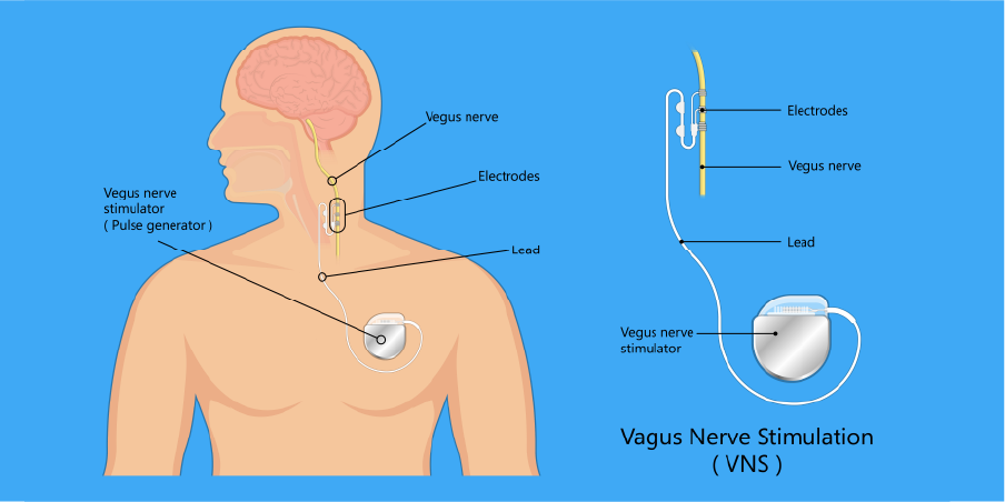 Epilepsy_Management 7