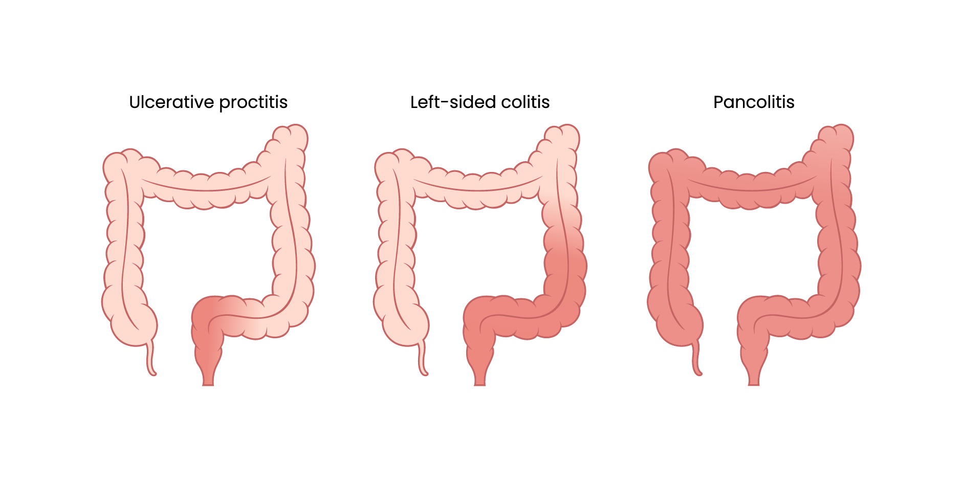 Inflammatory Bowel Disease_Management 1
