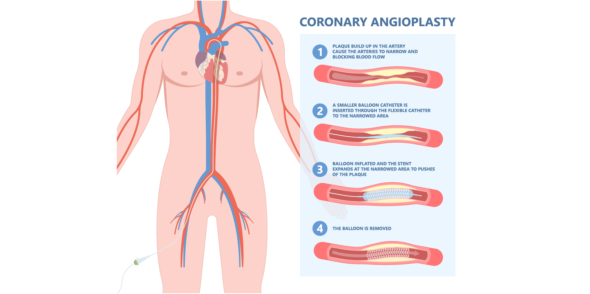 Chronic Coronary Syndromes_Management 12